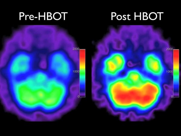 Hyperbaric Oxygen Therapy (HBOT) for Veterans with Mild TBI