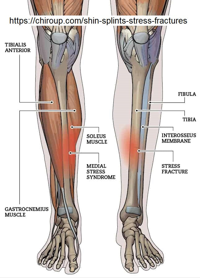 Fix Your Shin Splints (Medial Tibial Stress Syndrome) By Seth Donelson (DPT)